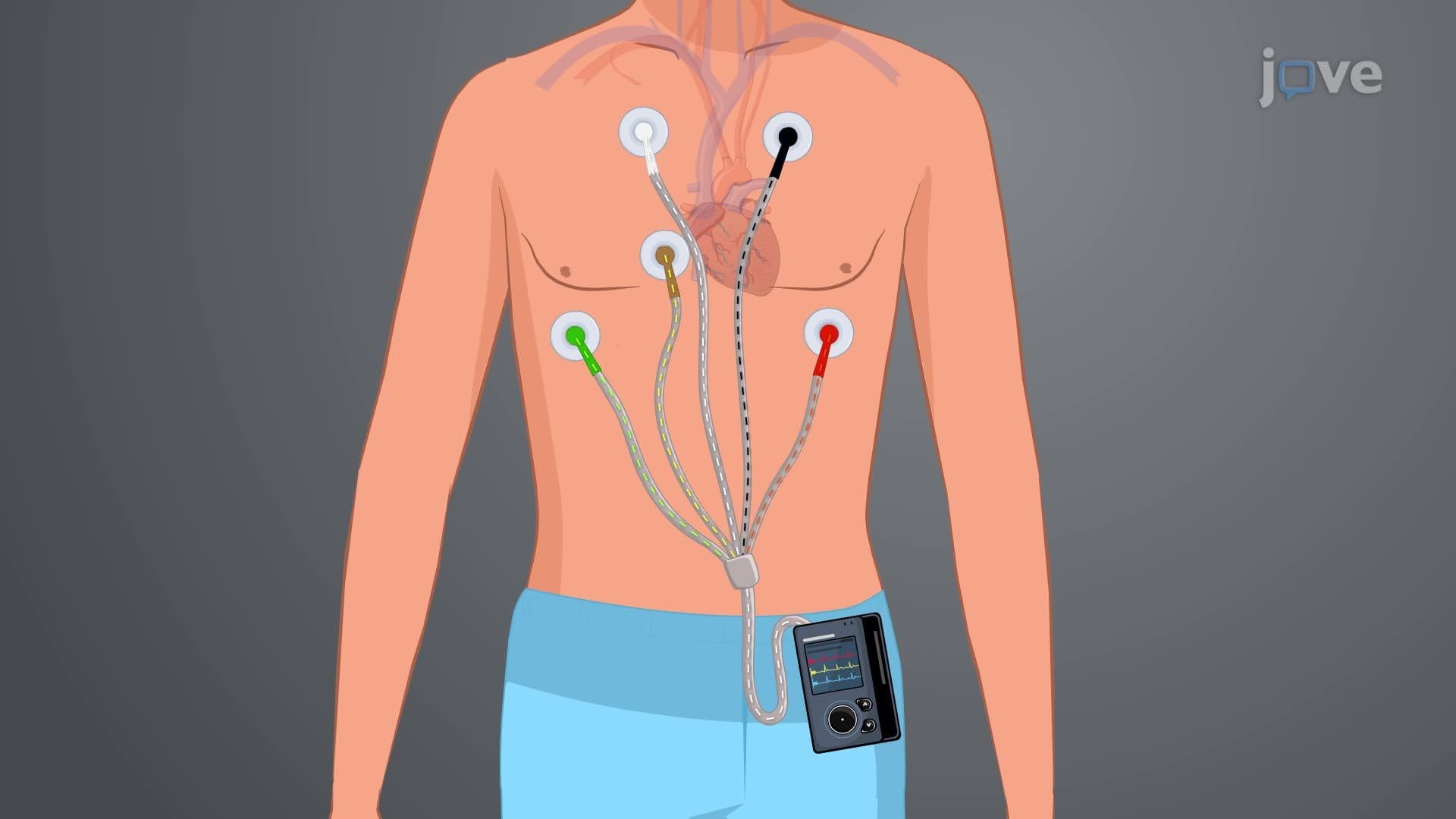 Holter Monitor: 24-Hour Monitoring