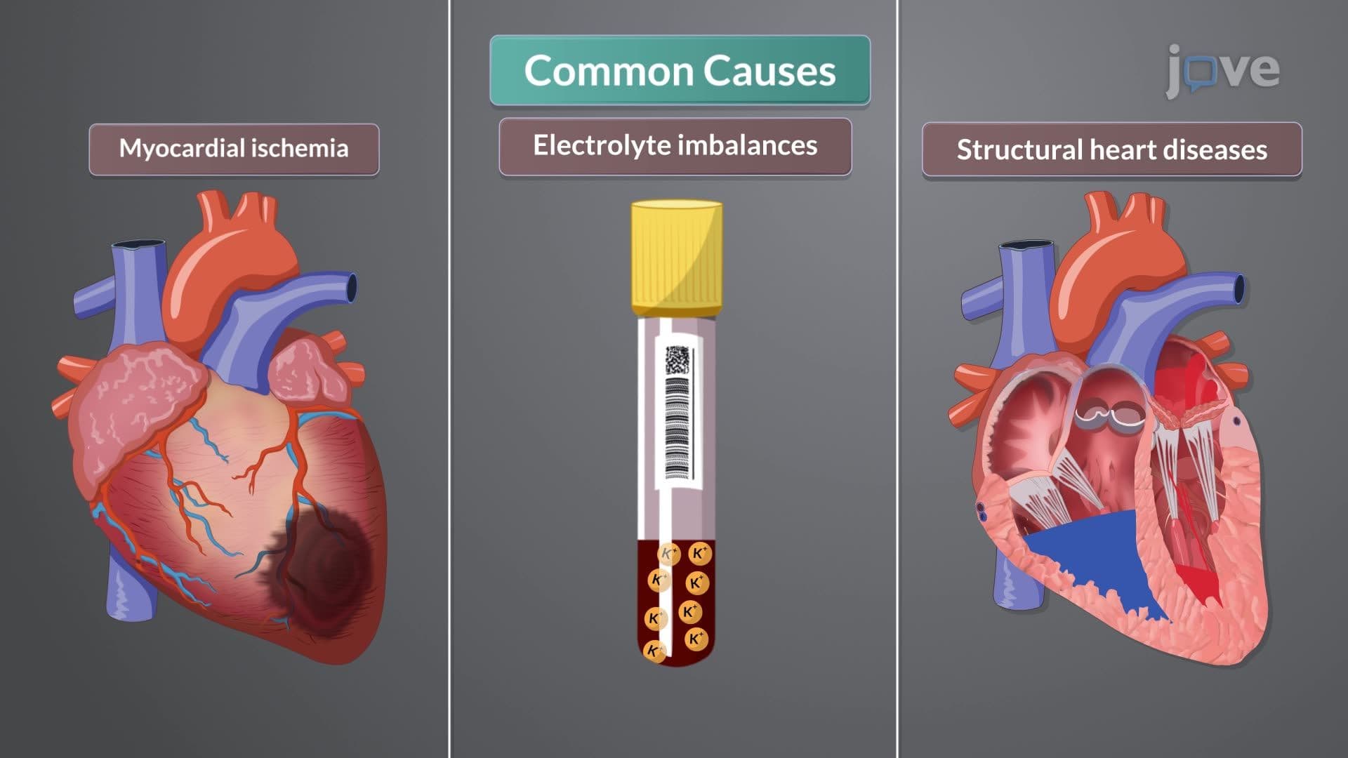 Cardiac Dysrhythmias and Heart Block