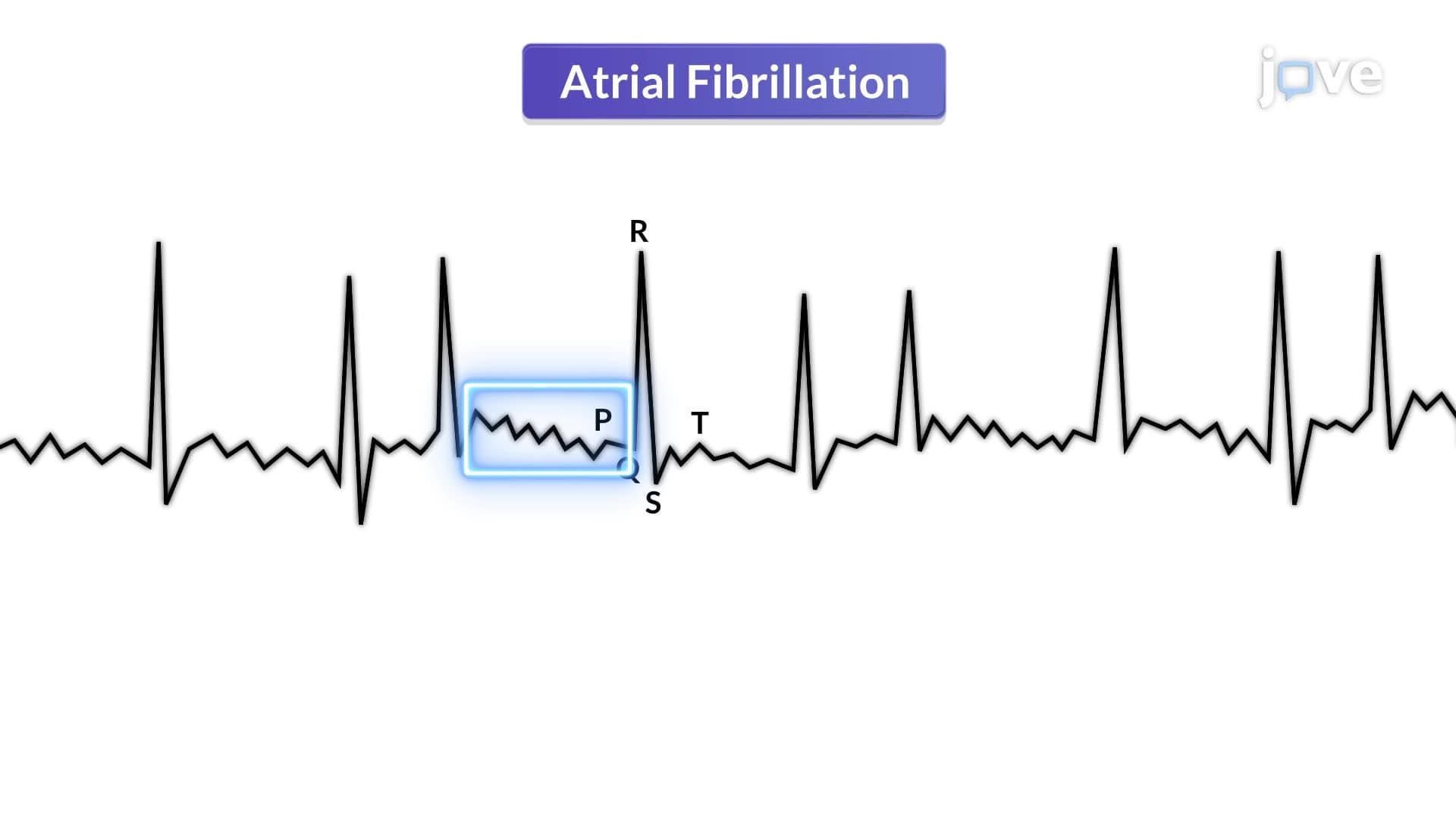 ECG Interpretation of Arrhythmias II: Atrial, Junctional and Ventricular Arrhythmias