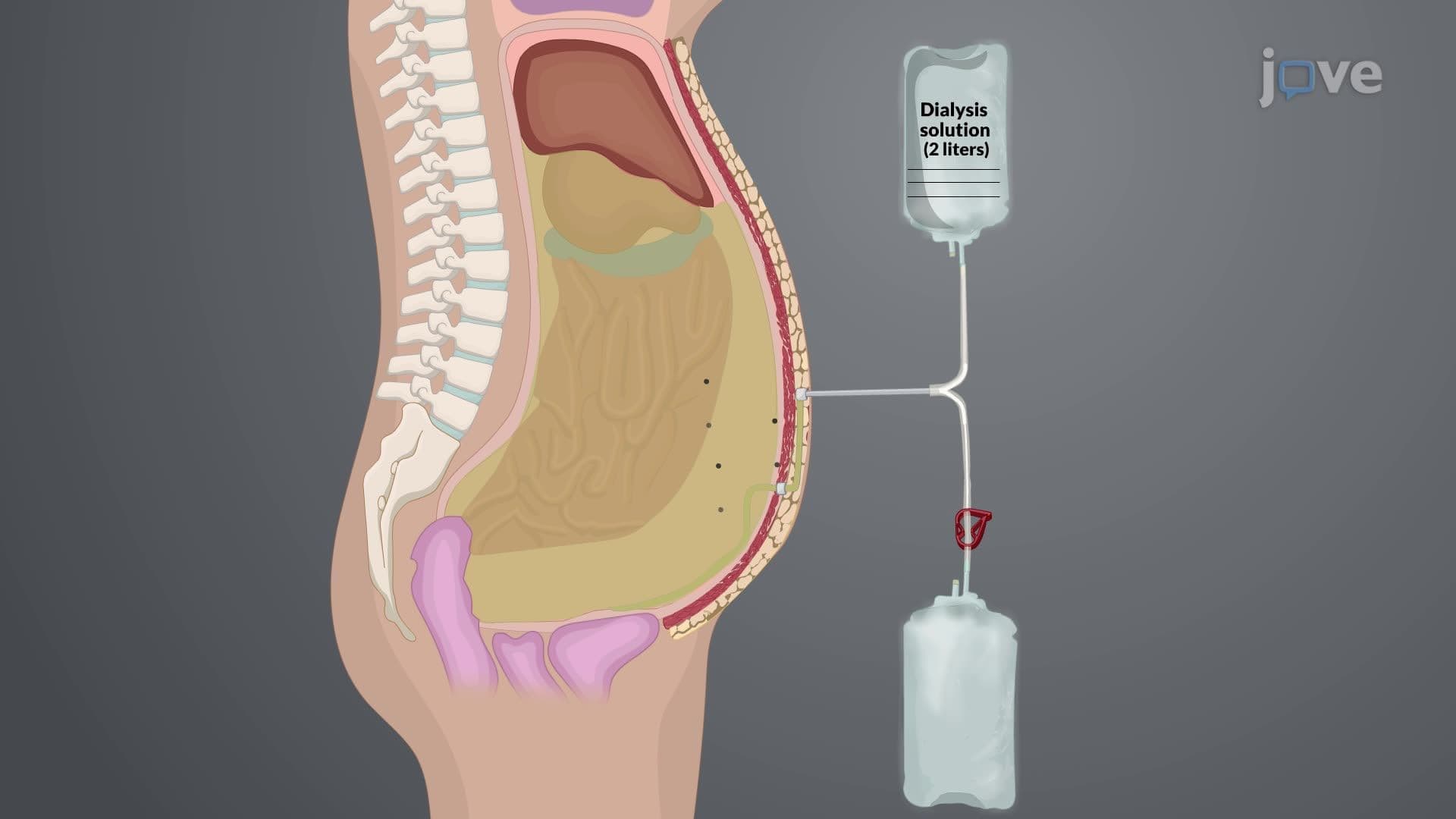 Dialysis and Renal Transplant