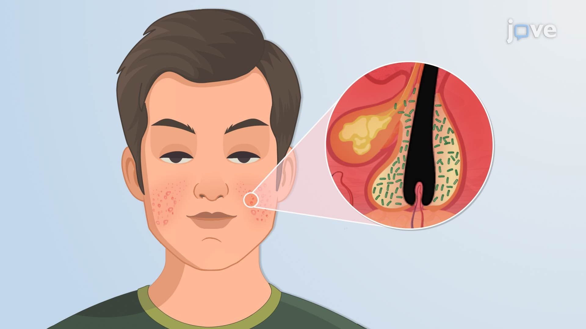 Acne Infection