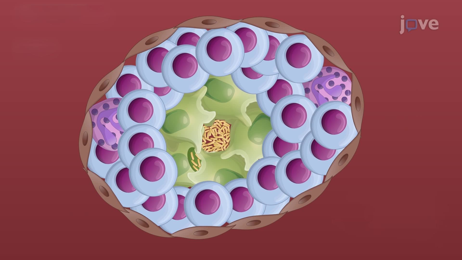Tuberculosis