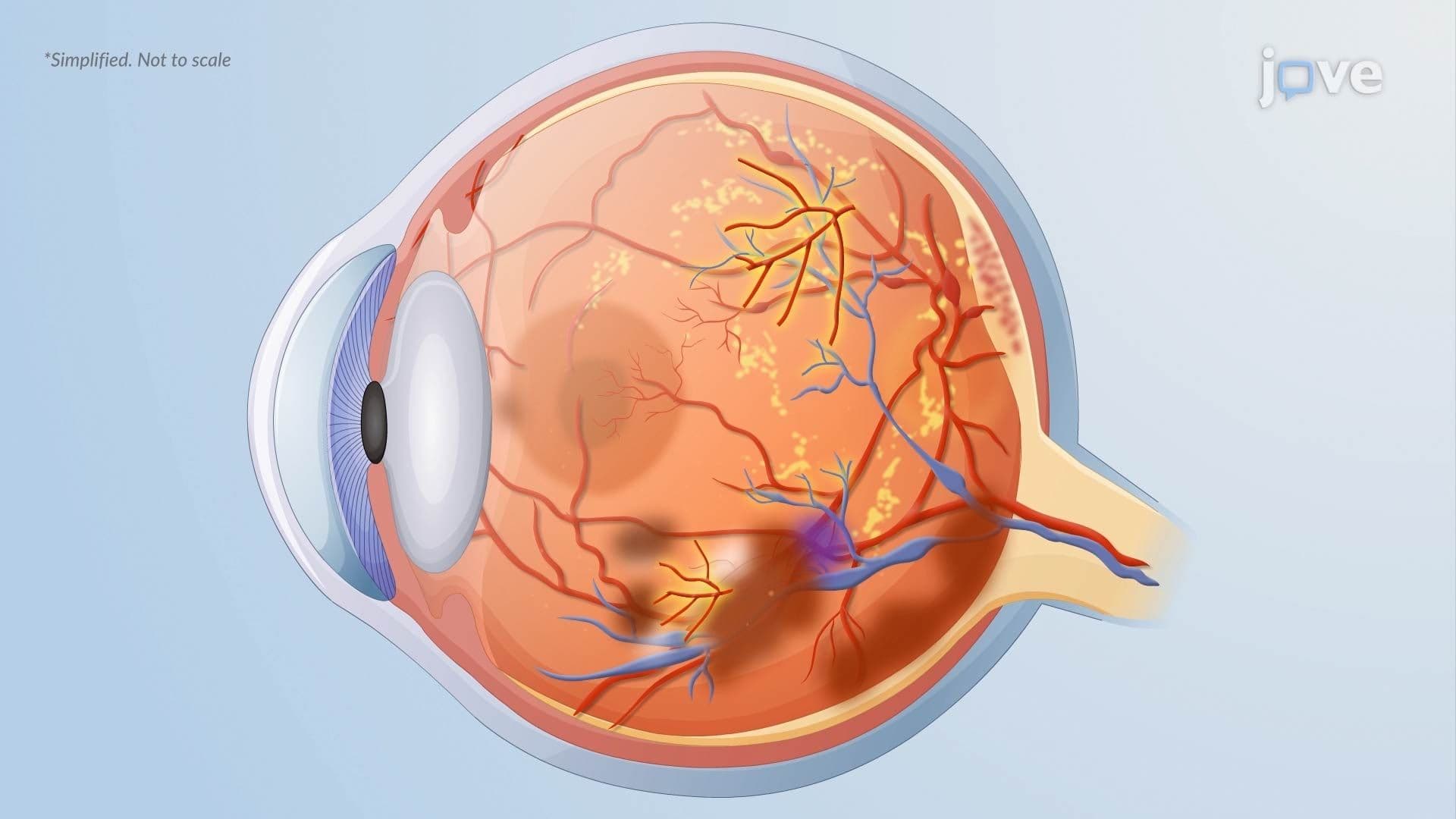 Diabetic Retinopathy