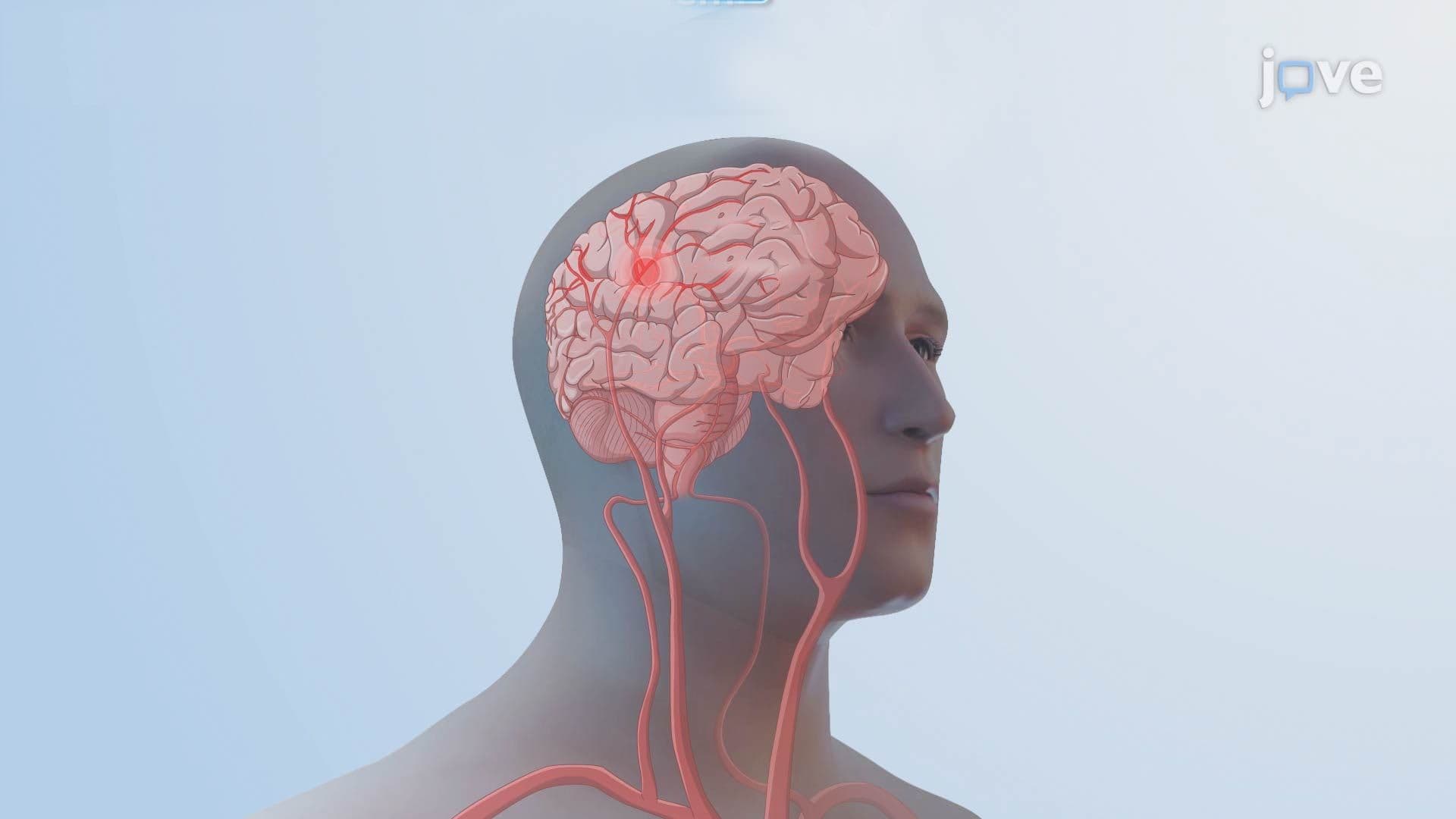 Ischemic Stroke l: Introduction