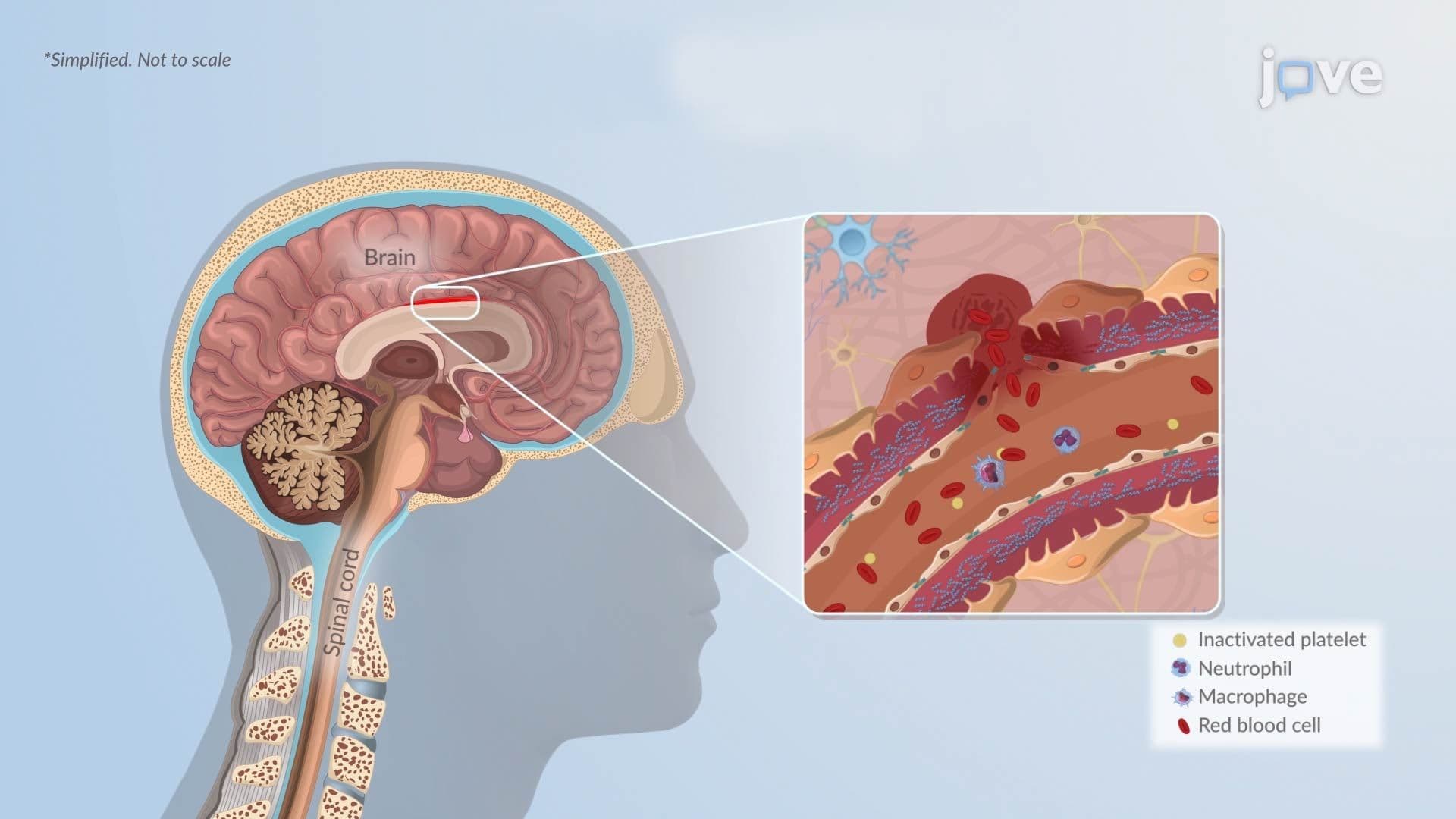 Hemorrhagic Stroke l: Introduction