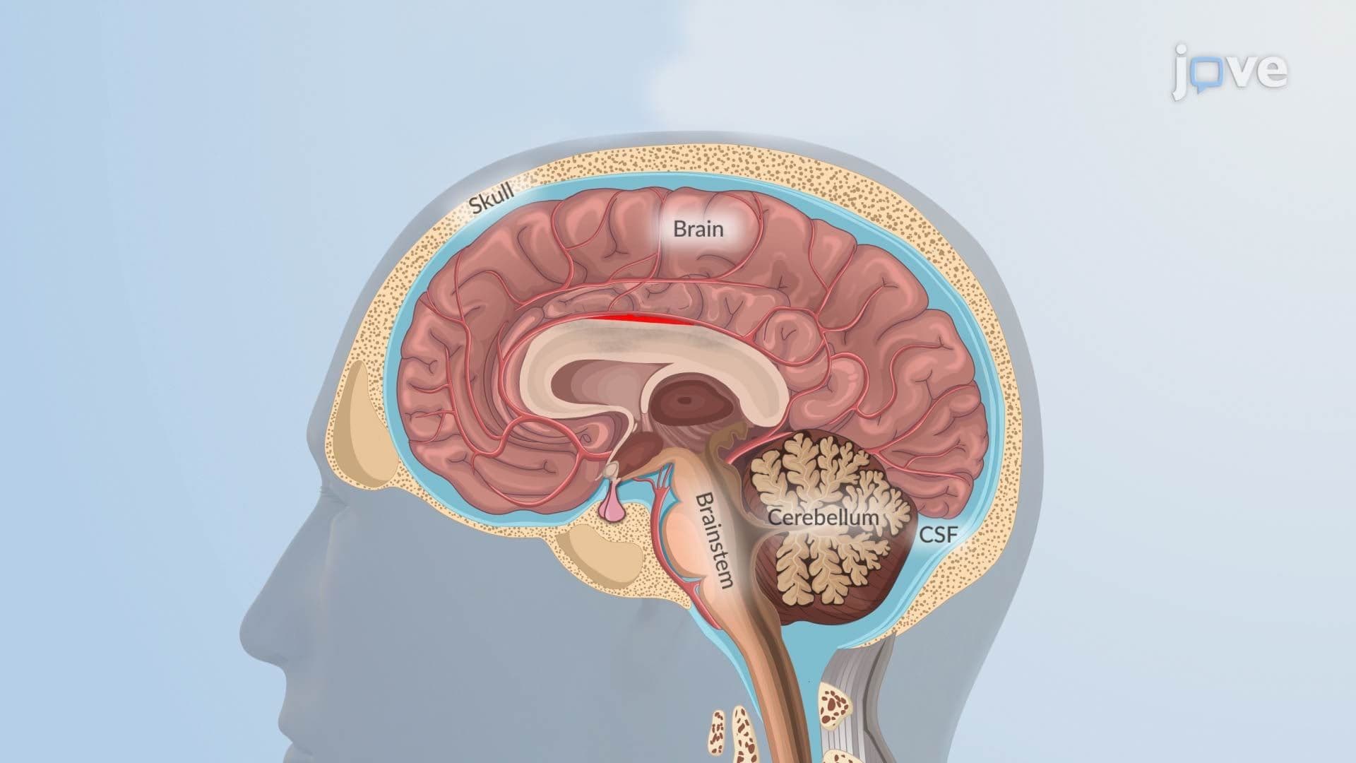 Hemorrhagic Stroke ll: Pathophysiology