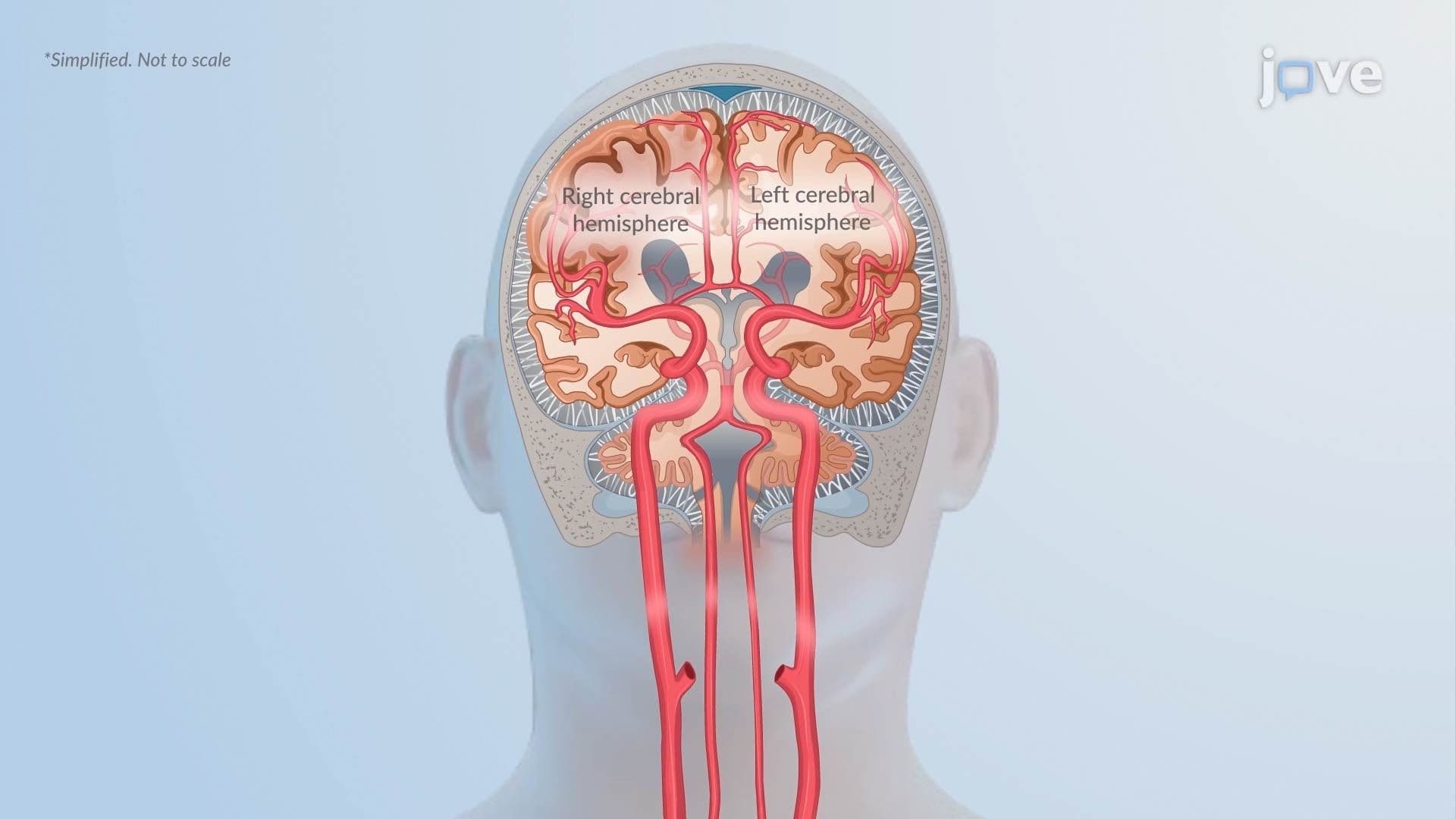 Increased Intracranial Pressure ll: Pathophysiology