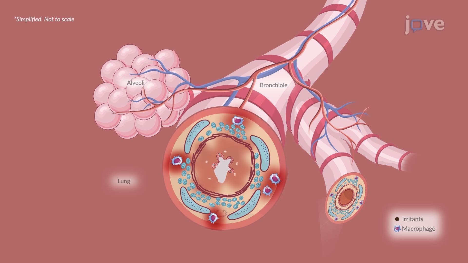 Chronic Obstructive Pulmonary Disease III: Chronic Bronchitis Features