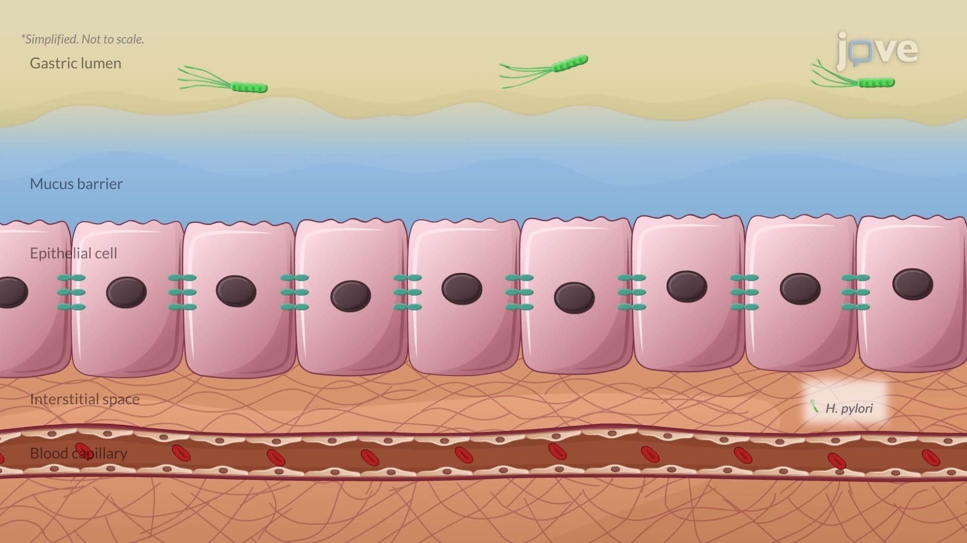 Gastritis II: Pathophysiology