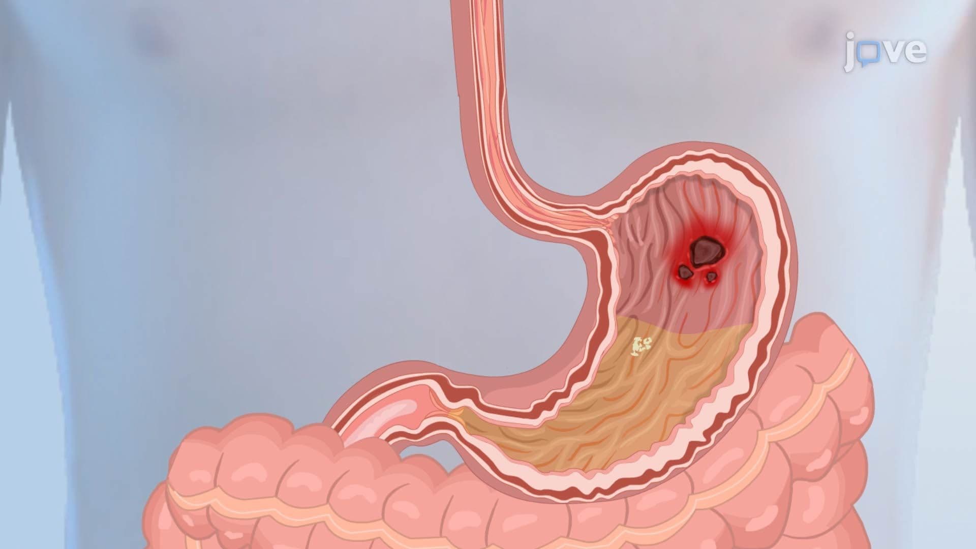 Peptic Ulcer Disease II: Pathophysiology