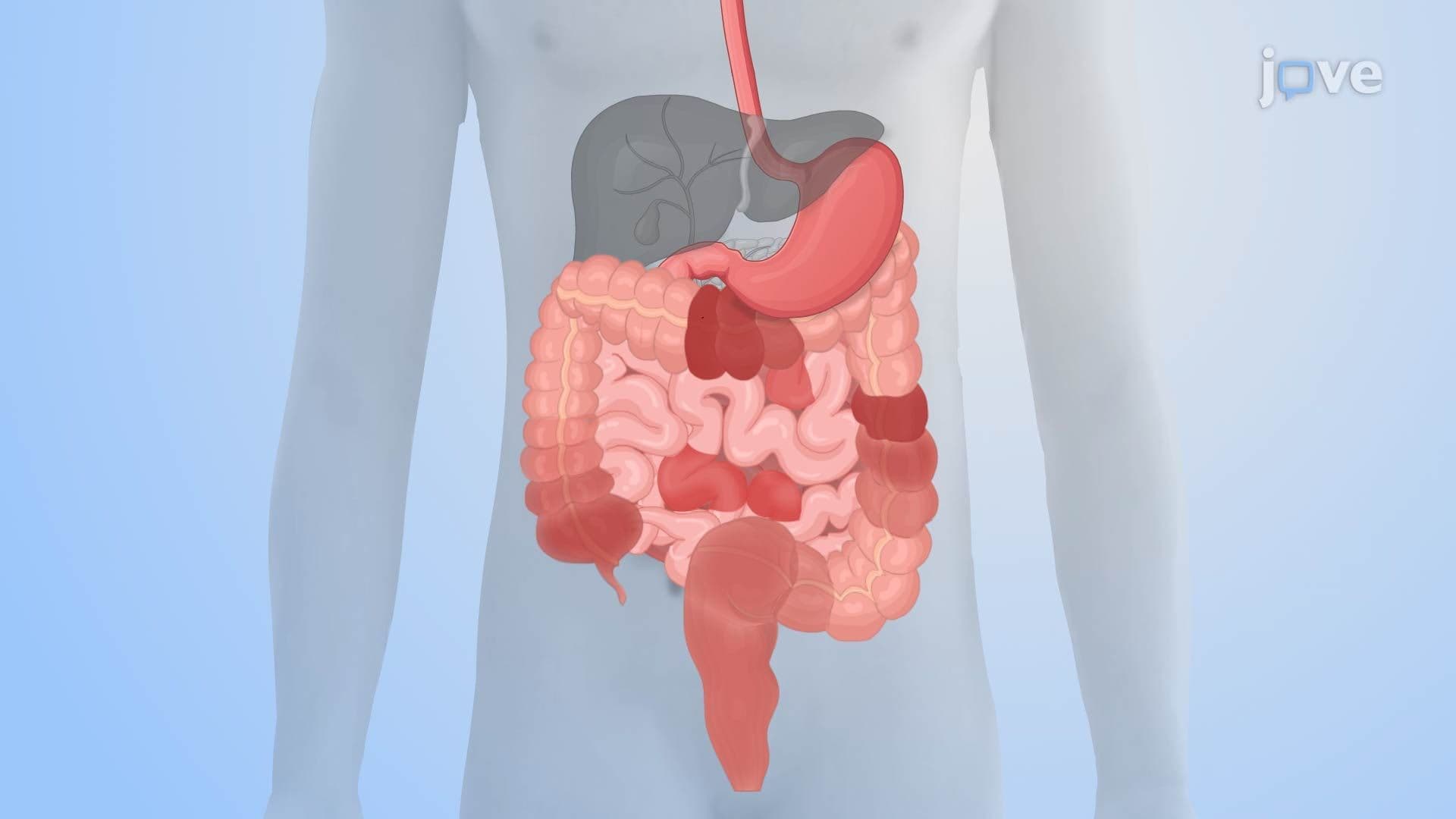 Inflammatory Bowel Disease I: Introduction