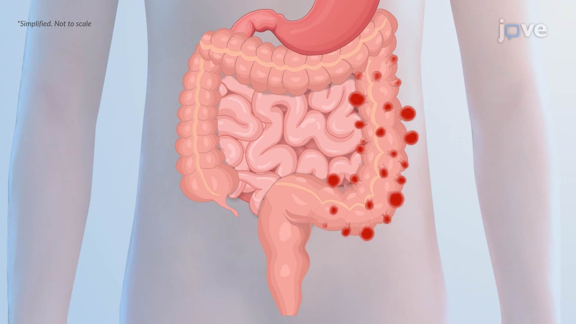 Diverticular Disease of the Colon