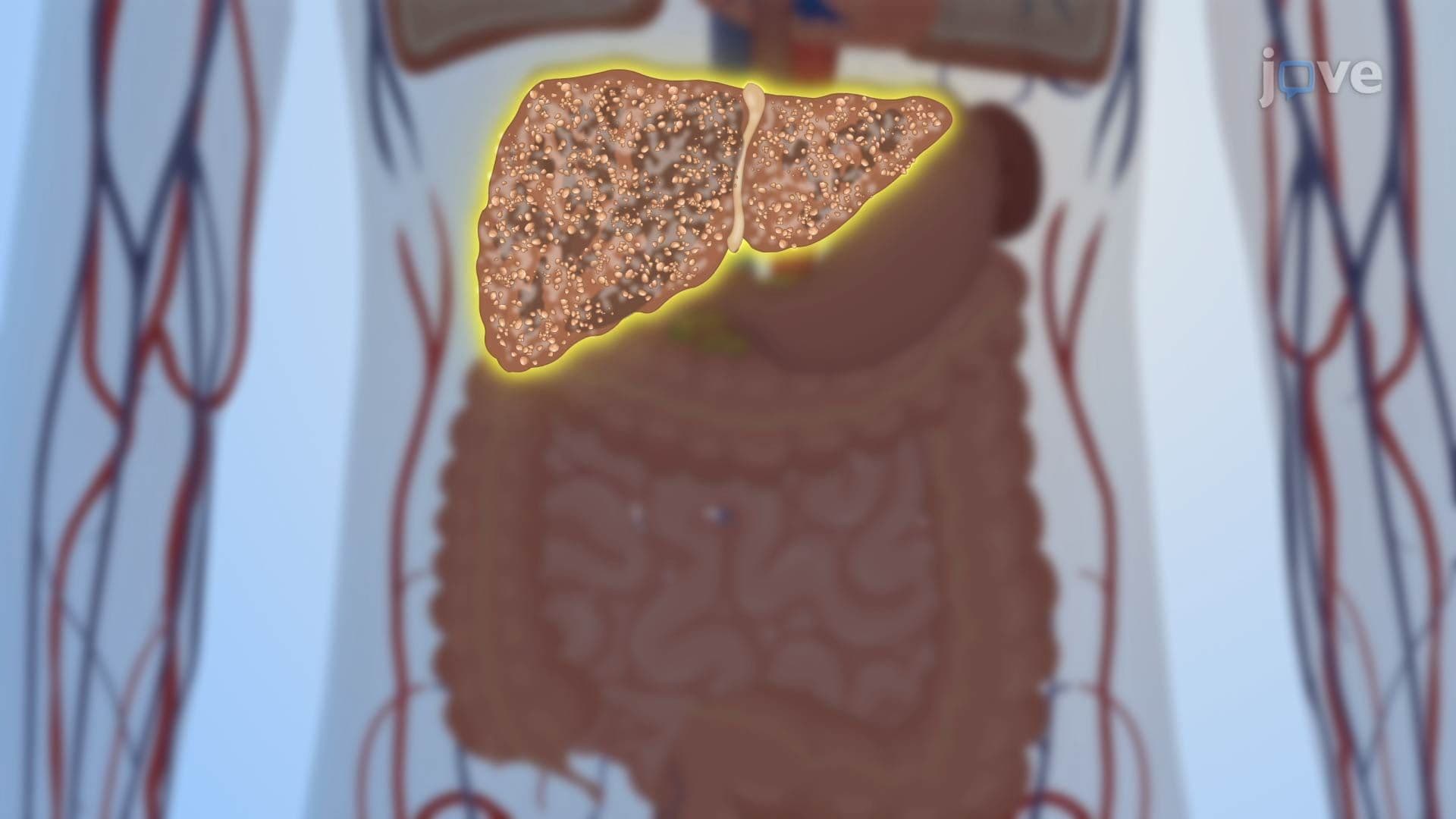 Cirrhosis II: Pathophysiology