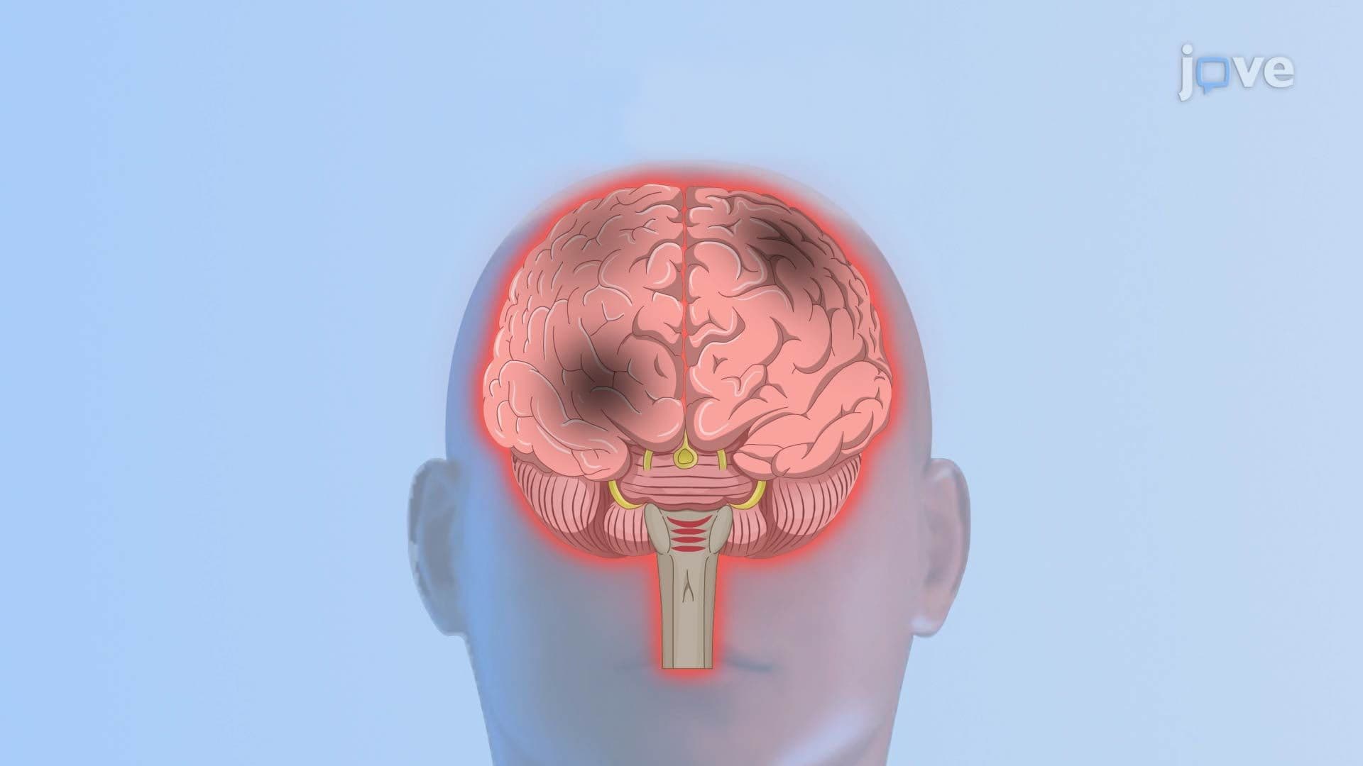 Hepatic Encephalopathy