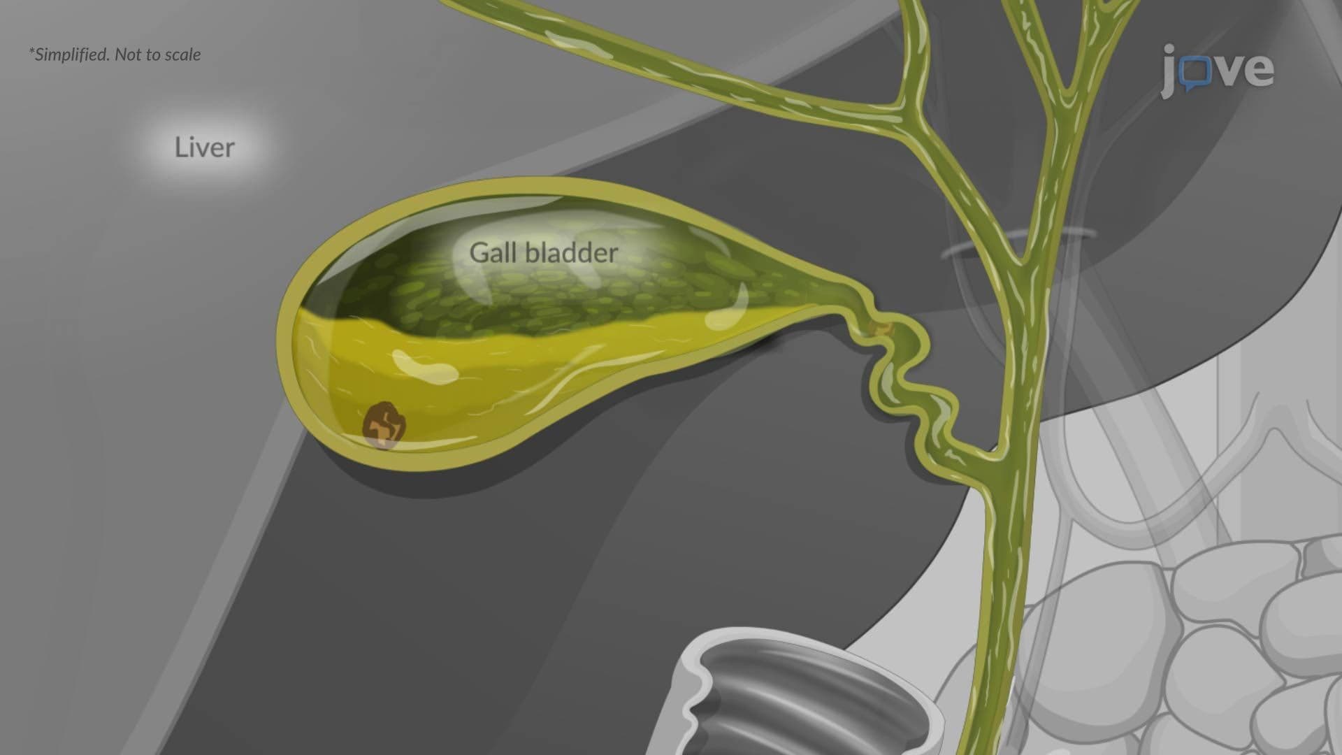 Cholecystitis