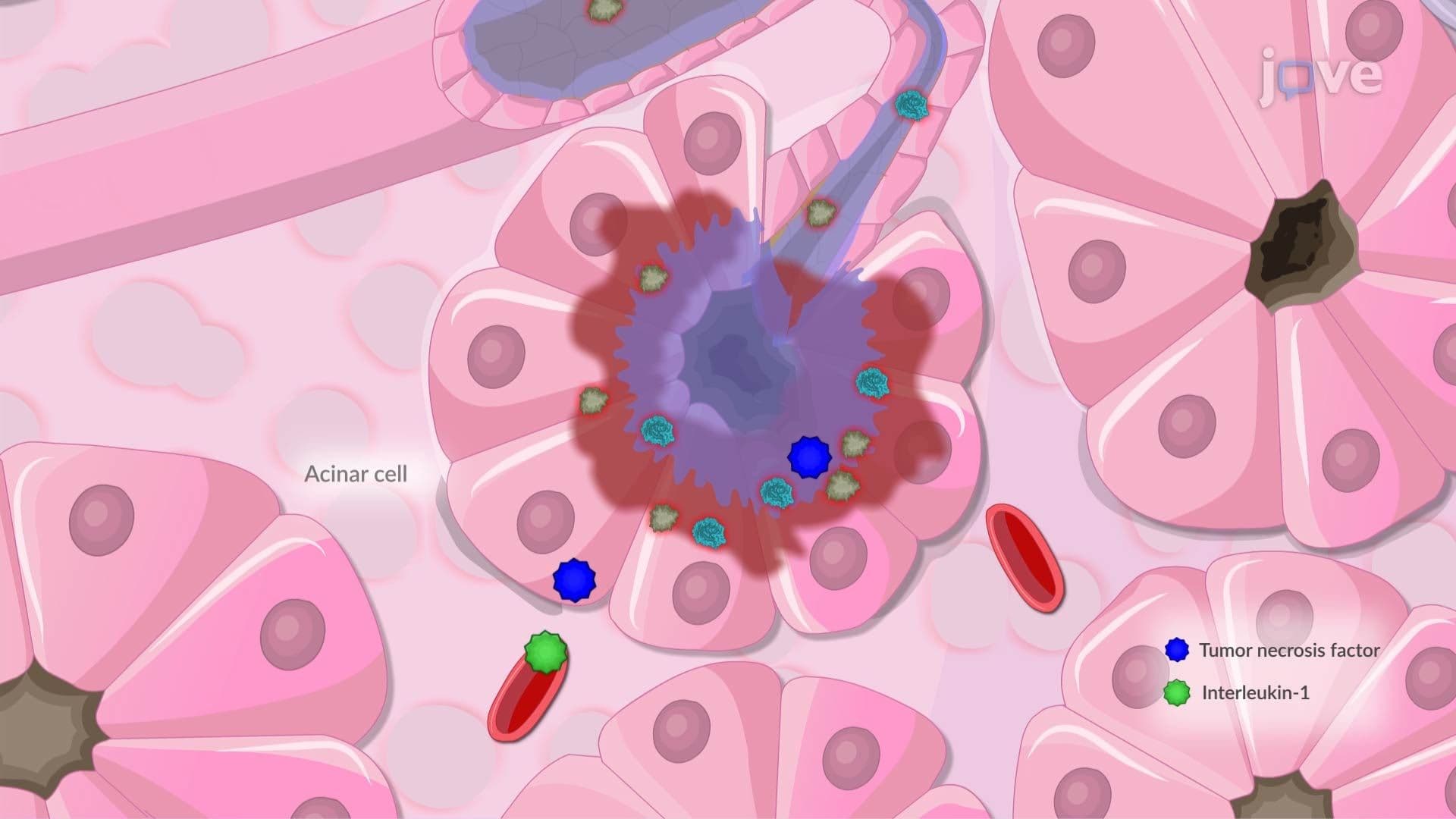 Acute Pancreatitis II: Pathophysiology