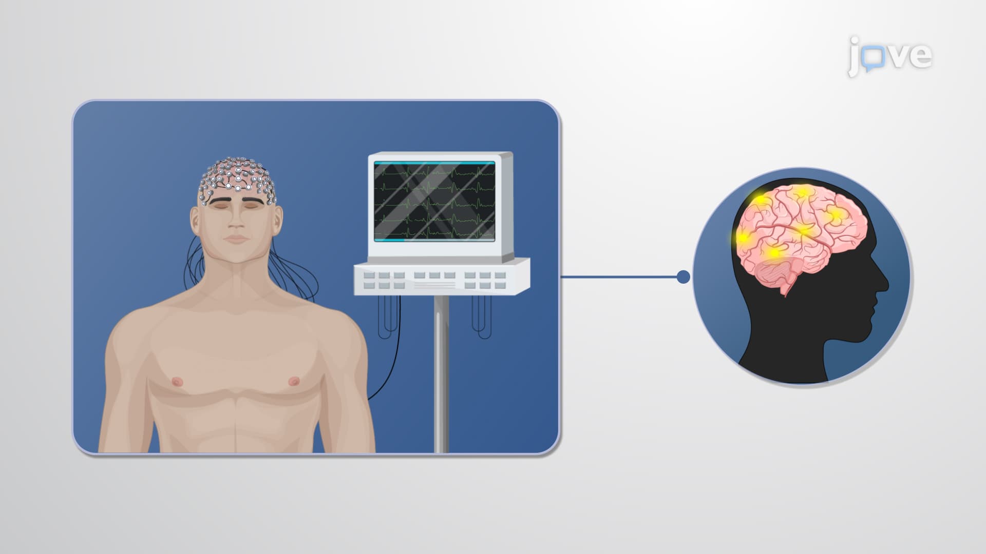 Epilepsy and Seizures: Overview