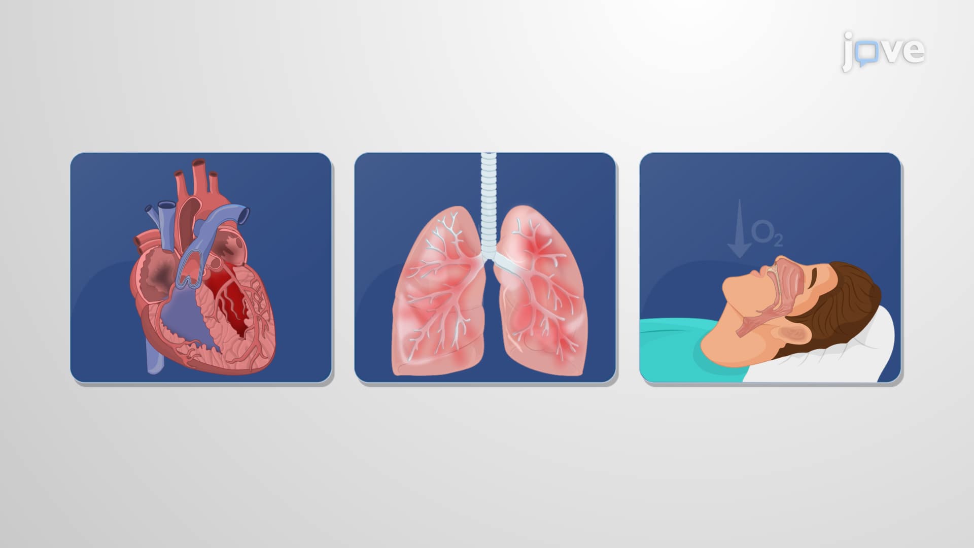 Other Respiratory Disorders