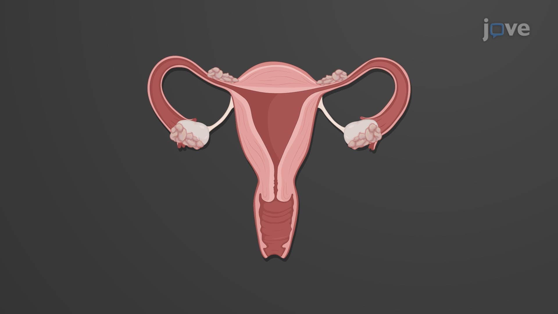 Infertility in Females