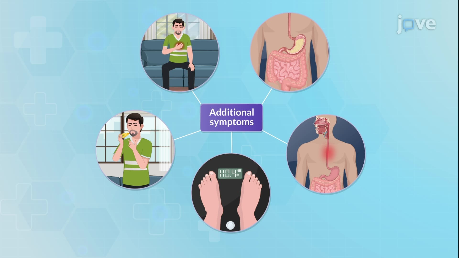 Esophageal Strictures-II: Clinical Features and Management