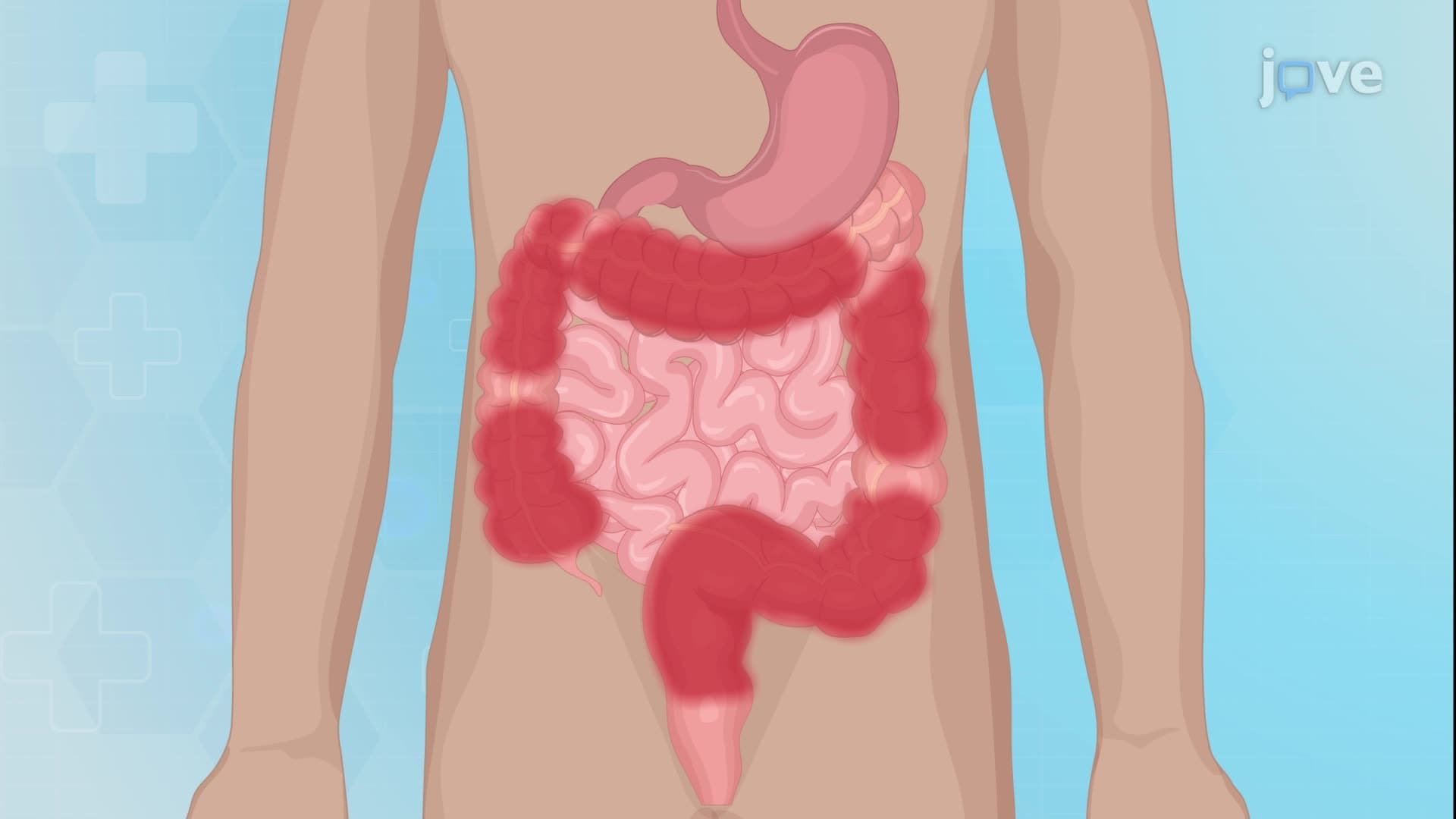 Inflammatory Bowel Disease V: Surgical Management