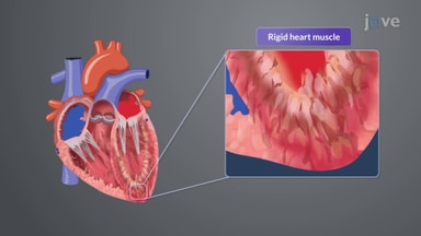 Cardiomyopathy