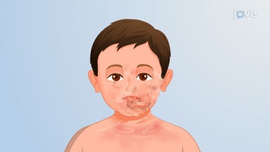 Bacterial Diseases